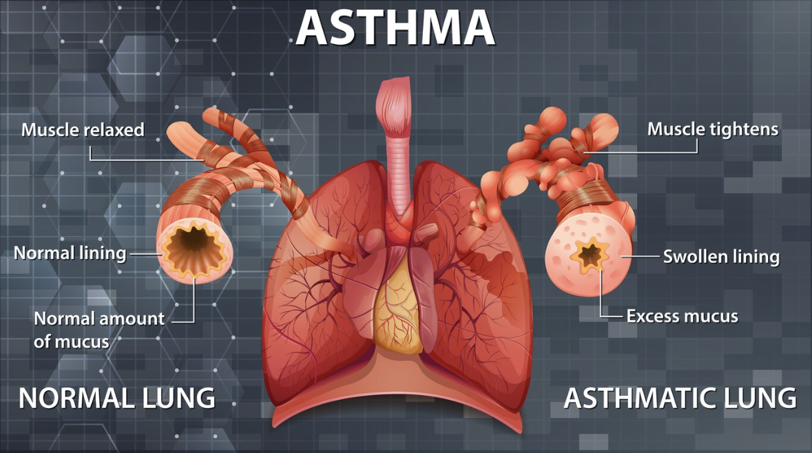 asthma.png