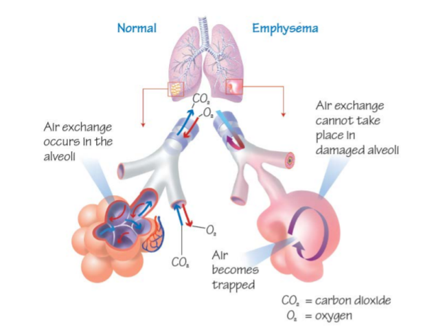 copd-graphic.png