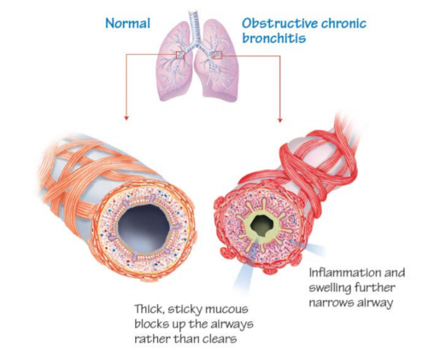 copd.png