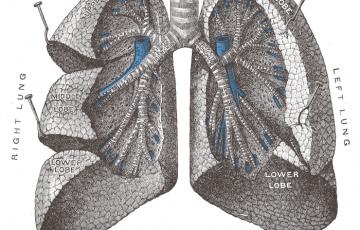 cystic fibrosis