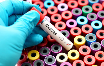 measles blood test