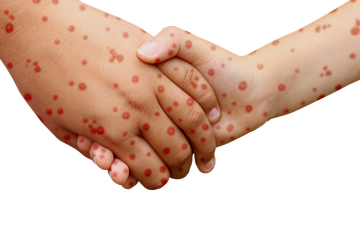 measles on hands