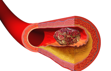 Warfarin Initiation Clinic